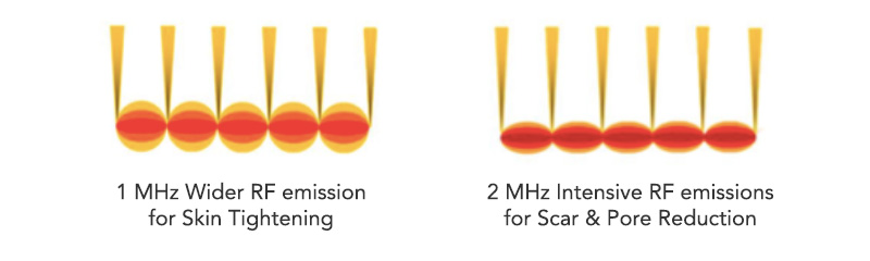 1 MHz Wider RF emission for Skin Tightening - 2 MHz Intensive RF emissions for Scar & Pore Reduction